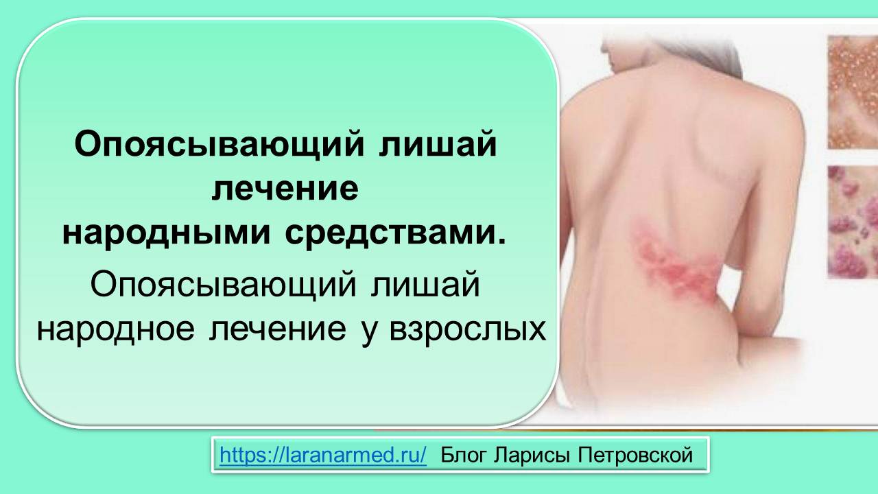 Опоясывающий лишай лечение народными средствами