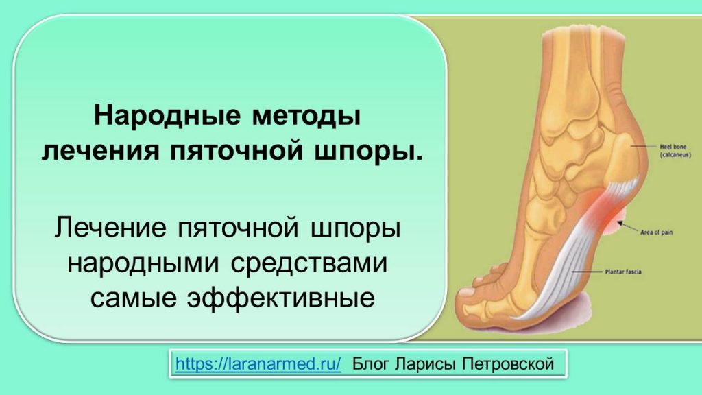 Народные методы лечения пяточной шпоры