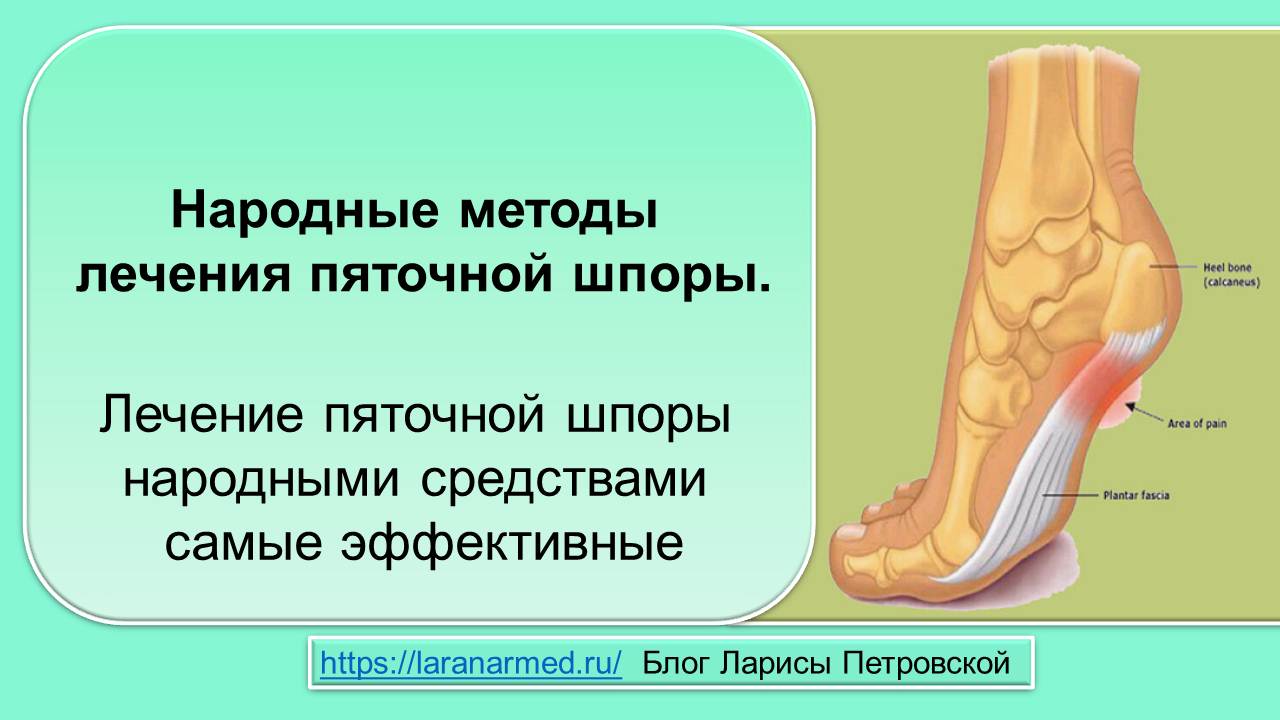 Народные методы лечения пяточной шпоры