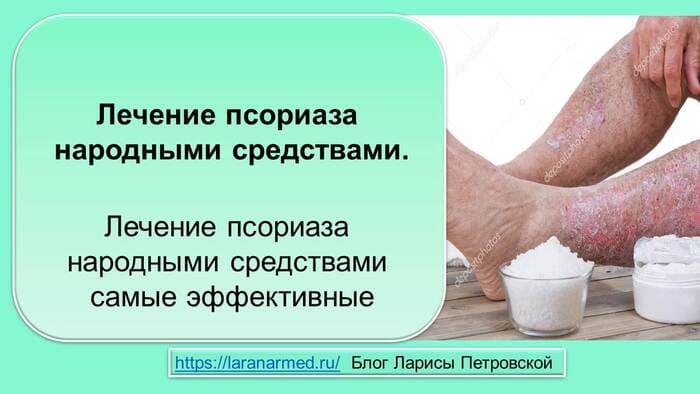 Лечение псориаза народными средствами