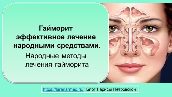 Гайморит эффективное лечение народными средствами